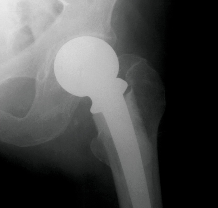 End application - joint replacement.