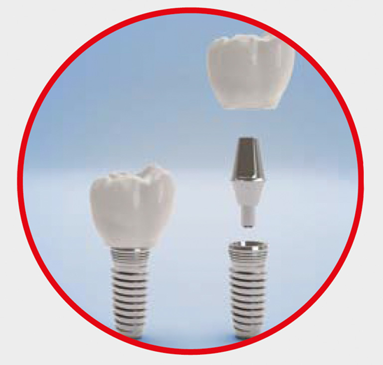 End application - dental implant. End application - dental implant.